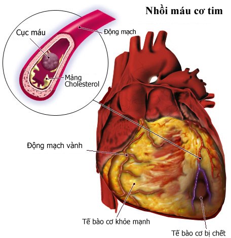 Nếu tình trạng trên kéo dài quá lâu, các tế bào cơ tim sẽ bị tổn thương không thể phục hồi nên dẫn đến đột quỵ gây tử vong nhanh chóng.