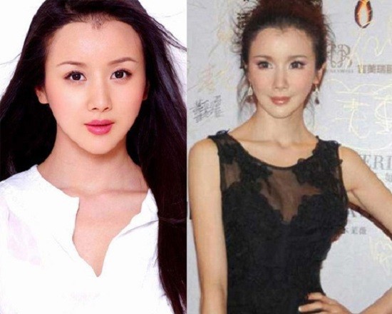 Nữ diễn viên  Tôn Phi Phi của Trung Quốc là sản phẩm bị lỗi của phẫu thuật thẩm mỹ.