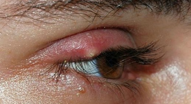 Mẹo hay chữa lẹo mắt “thần tốc” tại nhà không để lại sẹo