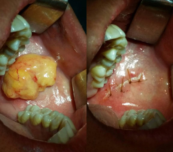 Quá trình này bác sỹ sẽ rạch 2 bên má từ phía trong miệng, đồng thời rút bớt mỡ từ 2 bên má, sau đó khâu lại vết rạch.