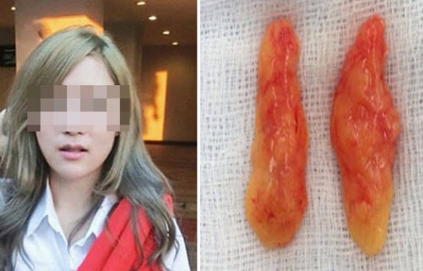 Trước đây một cô gái người Thái Lan cũng từng công khai ảnh phẫu thuật cắt mỡ má.