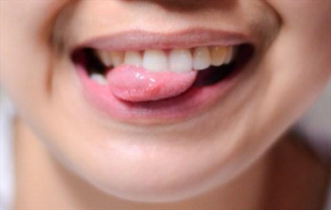 Sưng lưỡi - một triệu chứng khác ít biểu hiện của thiếu sắt là viêm teo lưỡi, khiến lưỡi bị sưng và đau.