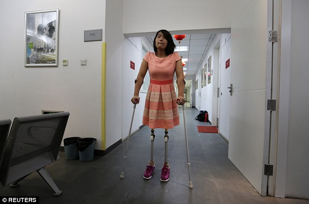 Năm 2013, Qian Hongyan, 18 tuổi chuẩn bị lắp một đôi chân giả mới ở Trung tâm Phục hồi chức năng Trung Quốc tại Bắc Kinh. Ảnh: Reuters.
