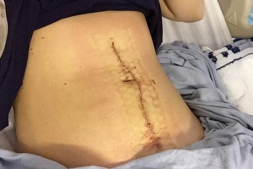 Thiếu nữ 21 tuổi bất ngờ bị nổ tung bụng như phim kinh dị