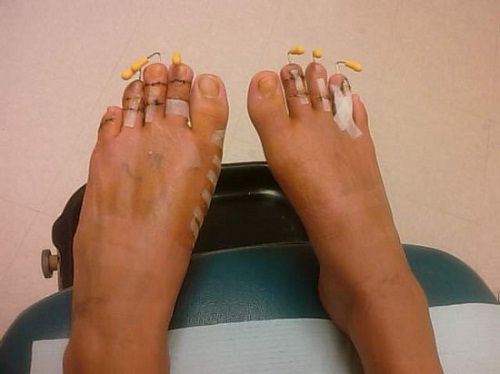 Ngoài phẫu thuật thu gọn bắp chân nhiều chị em còn phẫu thuật cắt ngắn bớt ngón chân.