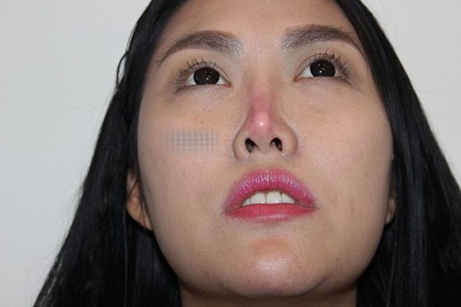 Trước đây, Phi Thanh Vân cũng bị biến chứng teo, vẹo mũi sau 10 năm đặt silicon sống mũi.