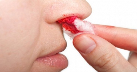 Chảy máu cam trong ung thư vòm họng thường có tính chất là bất ngờ, không có va chạm rõ ràng và thường kèm theo nhày hoặc dịch nước vàng.
