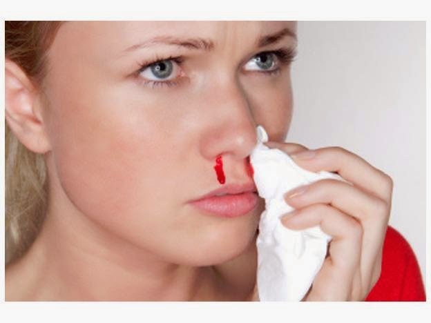 Đồng thời, chảy máu cam thông thường thường bắt nguồn từ mạch máu mũi trong lỗ múi, còn chảy máu cam do ung thư vòm họng thường bắt nguồn từ cửa mũi sau. Đó là do mỡ mạch máu mũi vì khối u ung thư phá hủy.