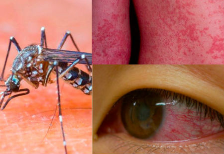 Virut zika - cách bắt bệnh và phòng ngừa hiệu quả nhất!