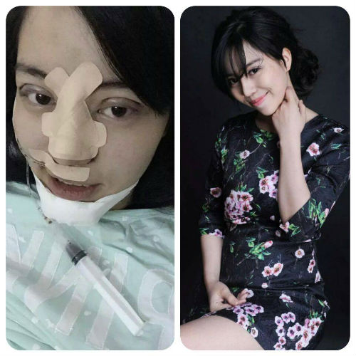 Sau 4 tháng phẫu thuật thẩm mỹ, cô bạn đã tự tin hơn với gương mặt của mình, bên cạnh đó cô bạn 9X cũng bật mí chi phí phẫu thuật không hề tốn kém.