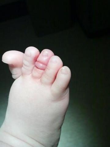 Trẻ có thể mất ngón chân, ngón tay chỉ từ một sợi tóc
