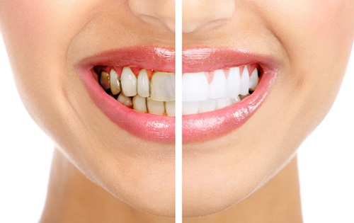 Răng luôn trắng, sáng bóng và hết cao răng chỉ 1 phút mỗi ngày