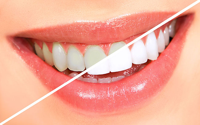 Tự lấy cao răng ở nhà chỉ 1 phút, không tốn tiền đảm bảo hiệu quả