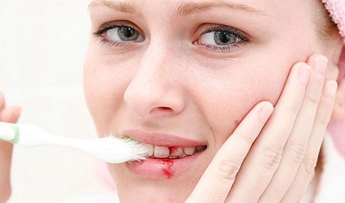 Chảy máu chân răng là bạn đang đối mặt với nhiều bệnh nguy hiểm