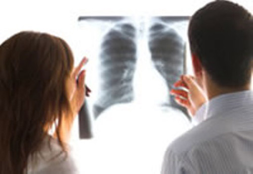 Dấu hiệu bạn đã mắc ung thư phổi giai đoạn đầu
