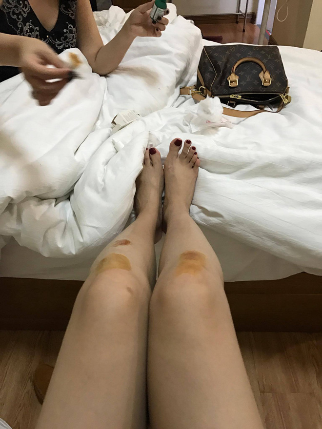 Phi Nhung bị ngã bầm tím chân vì vội vã chạy show