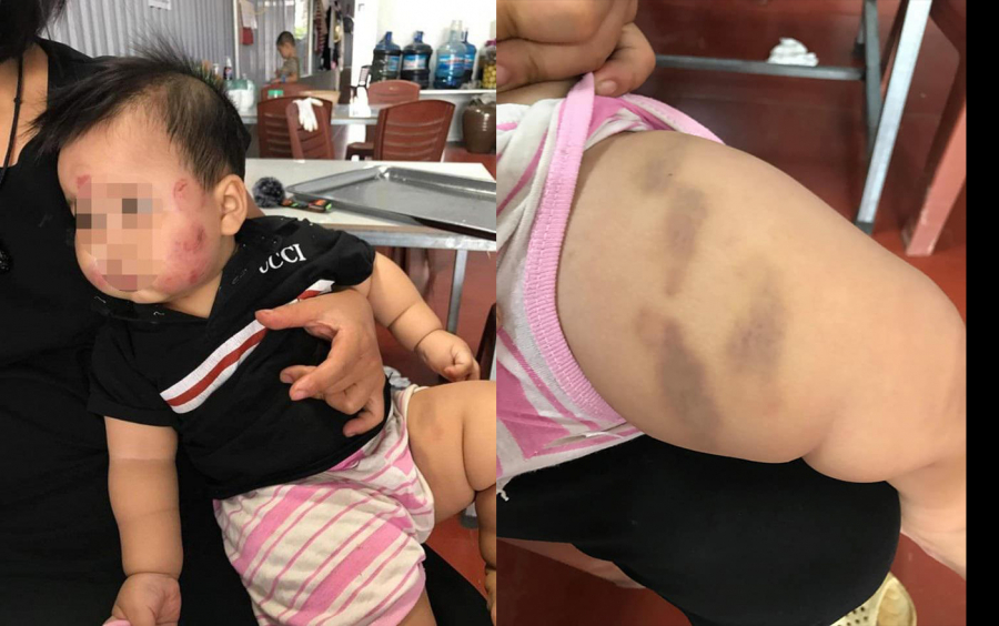 Bé N.M (10 tháng tuổi) xuất hiện nhiều vết thương trên đùi và mặt sau khi đi học tại trường mầm non về.