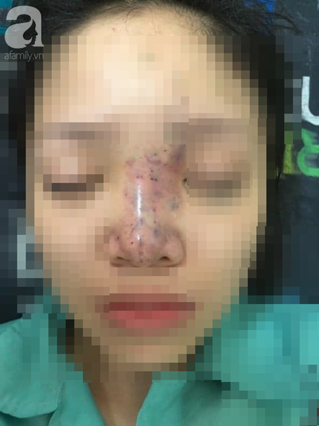 Tiêm filler nâng mũi, nữ sinh viên 20 tuổi ở Sài Gòn đối diện nguy cơ hoại tử da, mù mắt vĩnh viễn