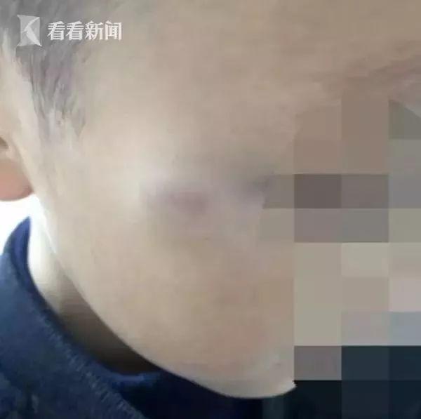 Gương mặt của Tiểu Húc bị cô giáo đánh bầm đến nay vẫn chưa khỏi.