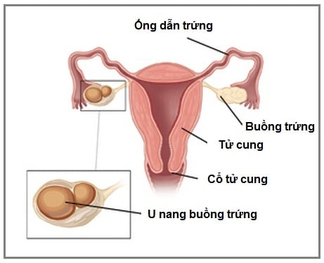 dau-hieu-u-nang-buong-trung2