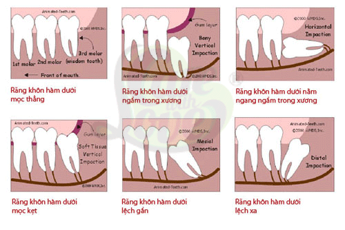 Một số vị trí mọc răng khôn