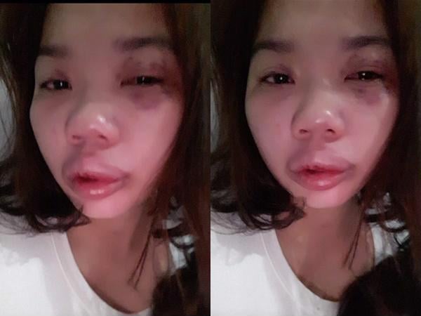 Cô gái trẻ bị chồng đánh bầm dập, không còn nhận ra nguyên dạng khuôn mặt
