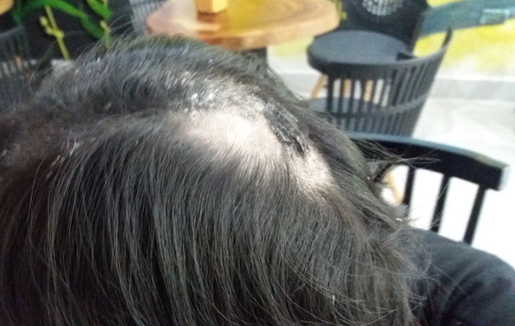 Mái tóc bết và da đầu bị ảnh hưởng bởi keo 502 của cô gái