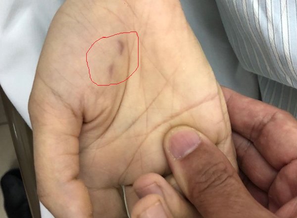 Vết cắn trên tay bệnh nhân