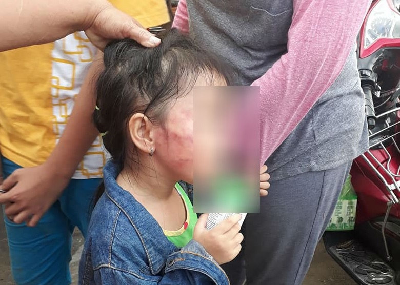 Bé gái 5 tuổi bị cô giáo đánh sưng mặt