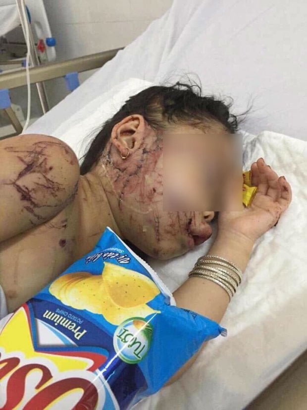 Bé Hân, 6 tuổi, một trong 4 nạn nhân may mắn sống sót sau vụ xe rước dâu gặp nạn ở Quảng Nam