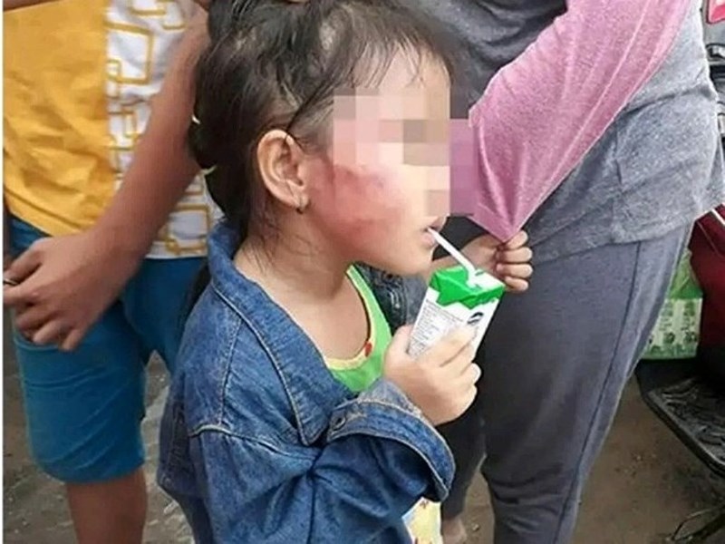 Bé D. bị cô giáo đánh sưng mặt, mấy ngày sau, gia đình đưa đi khám và phát hiện bé có cục máu trong tai và bị viêm tai giữa