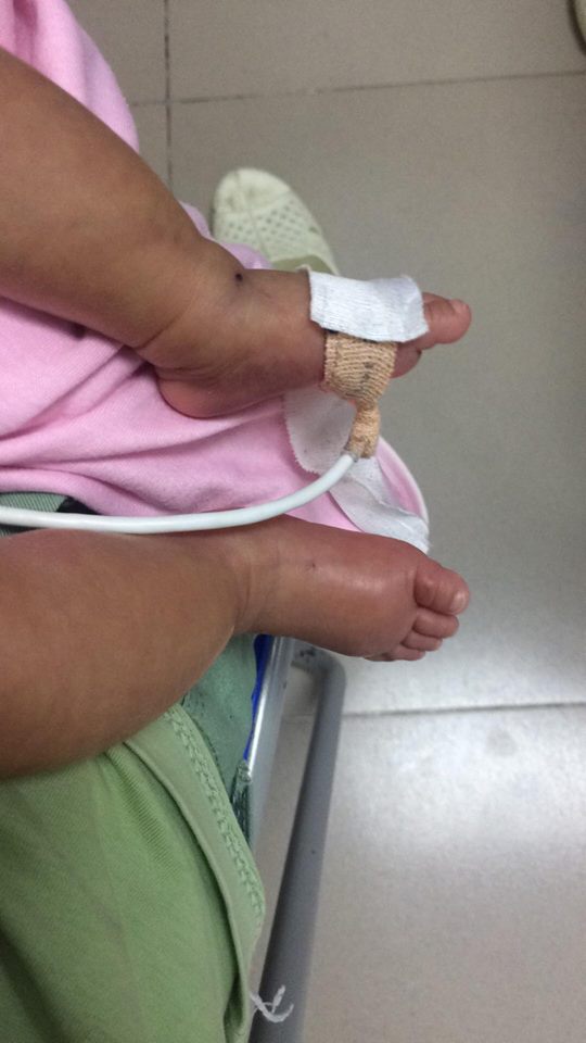 Đôi chân phù nề của đứa trẻ sinh non lại mang bạo bệnh
