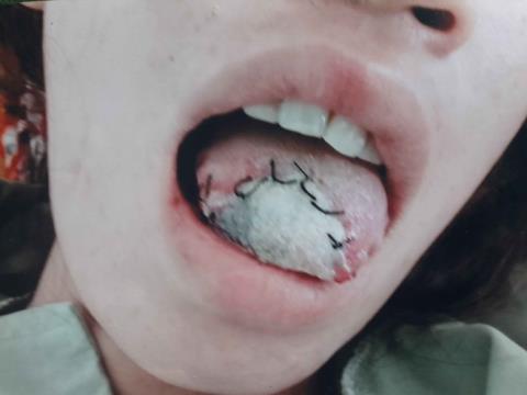 Phần lưỡi bị đứt của chị Nở không thể nối lại
