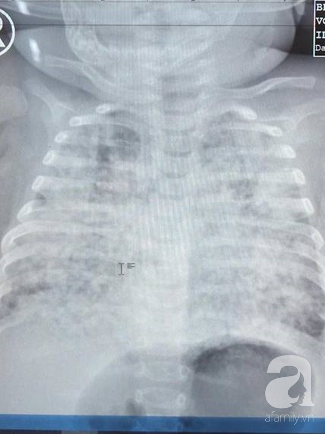 Ảnh chụp X-quang phổi bé trắng xóa