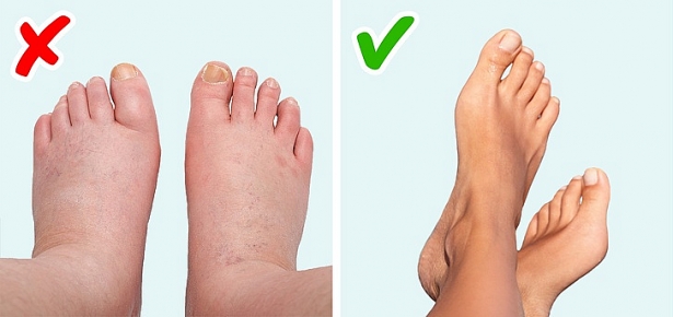 Ngón chân tự nhiên sưng phù có thể bạn đang mắc bệnh viêm khớp, gout và một số bệnh khác nguy hiểm tới sức khỏe.