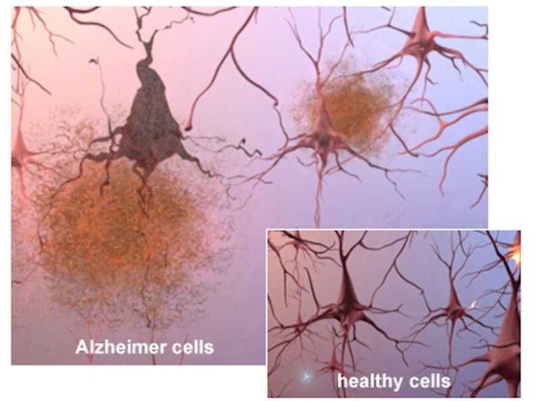 alzheimers-brain-cells-and-plaques-768x576