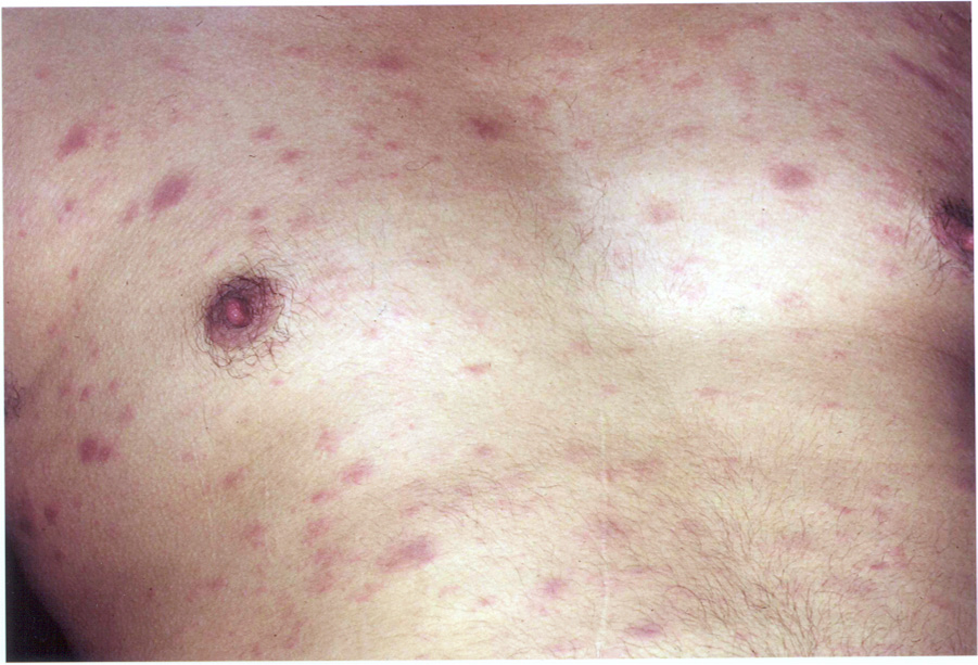 Biểu hiện, triệu chứng của bệnh HIV