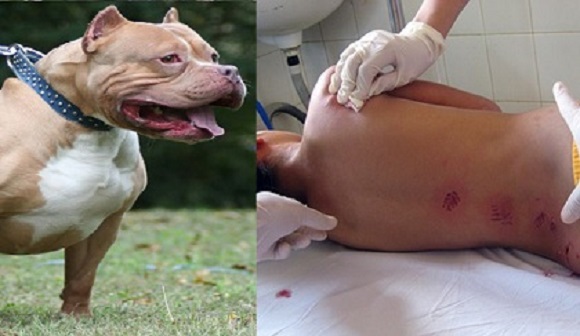 Người đàn ông bị chó Pitbull 30 kg cắn rồi lôi xuống hồ phải nhập viện