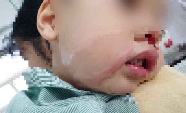 Vụ mẹ khiến con trai 2 tuổi bỏng nặng vì nhỏ nhầm axit: Lời cảnh báo cho các gia đình có trẻ nhỏ