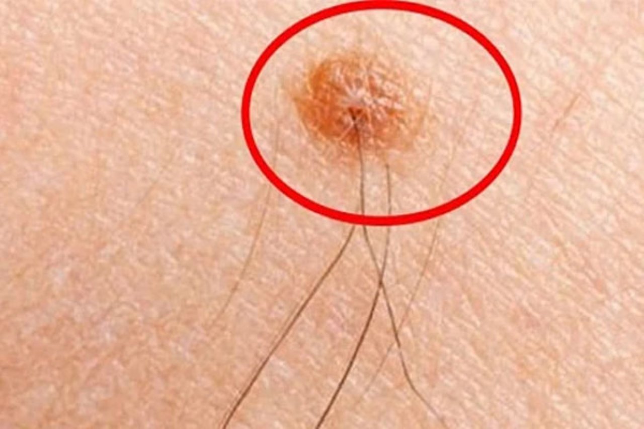 Lông mọc trên nốt ruồi