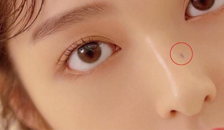 Nốt ruồi mọc ở giữa sống mũi hoặc gần chóp mũi được xem là tướng của người có nghị lực. Ảnh minh họa