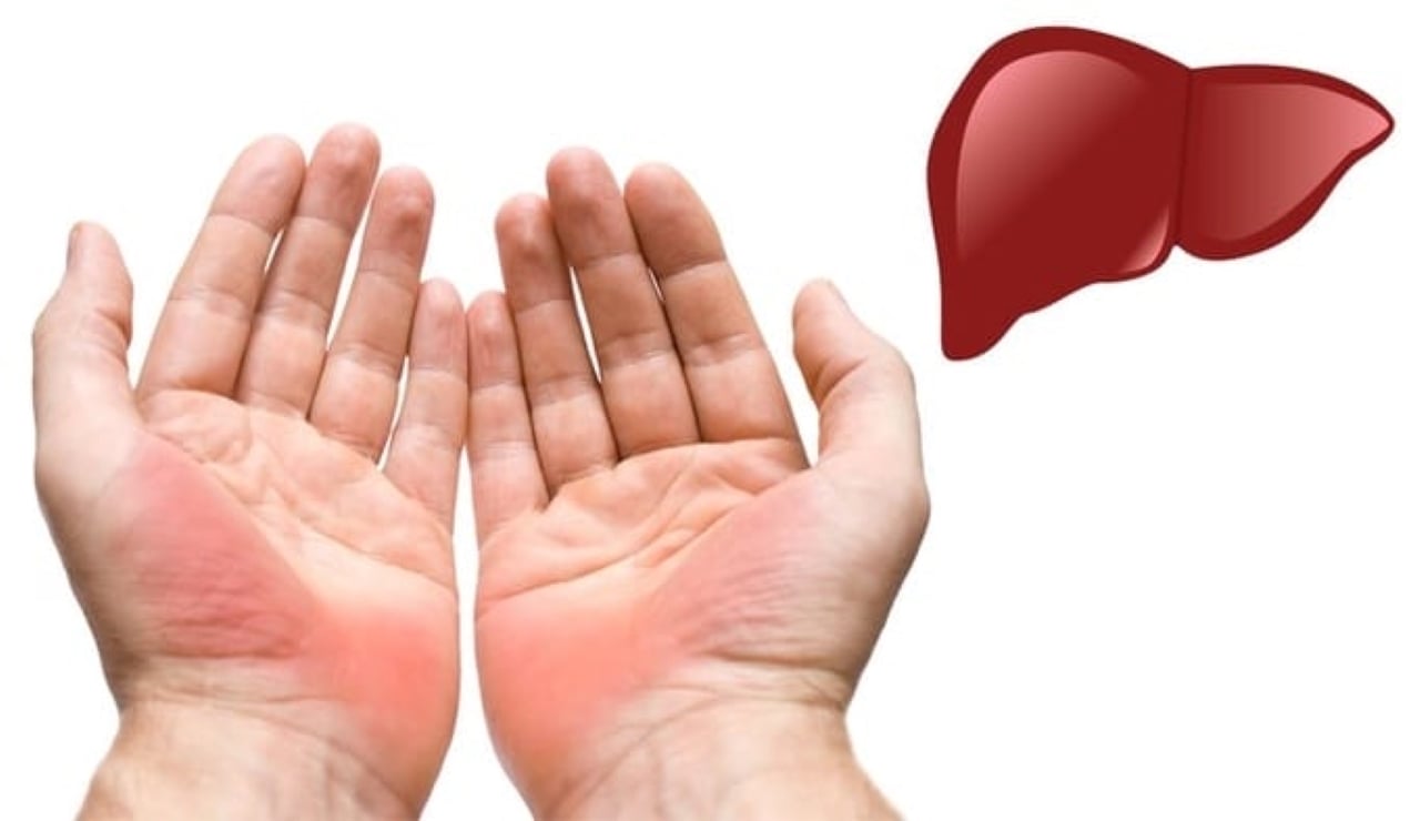 Lòng bàn tay màu đỏ hoặc ban đỏ có thể là dấu hiệu cảnh báo bệnh gan... (Ảnh minh họa)