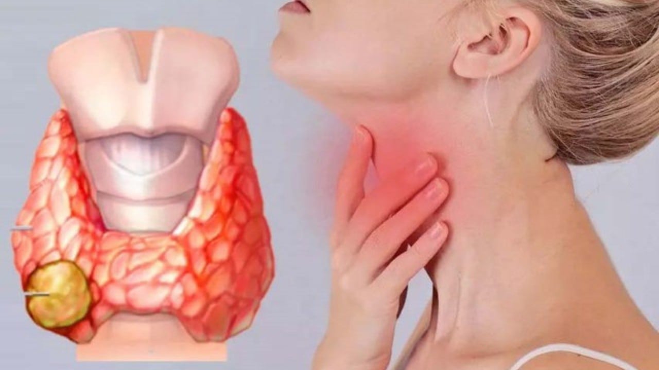 5 dấu hiệu ung thư tuyến giáp giai đoạn 1: Biết sớm sẽ kéo dài sự sống