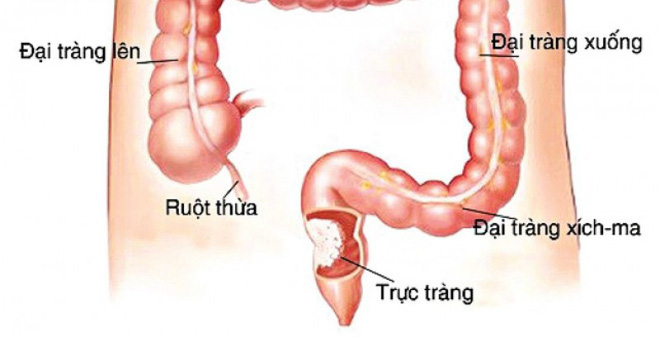Vị trí của trực tràng trong cơ thể người. Ảnh: Sức Khỏe Đời Sống.