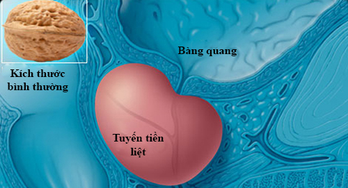 5 loại thực phẩm giúp ngăn ngừa ung thư tuyến tiền liệt