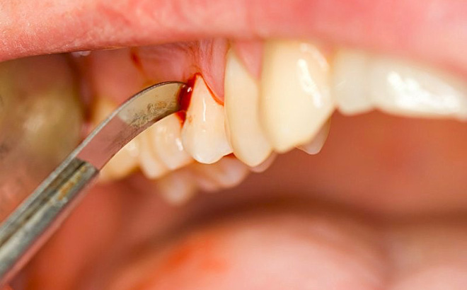  Có nhiều nguyên nhân gây ung thư răng do vệ sinh răng miệng không đúng cách 