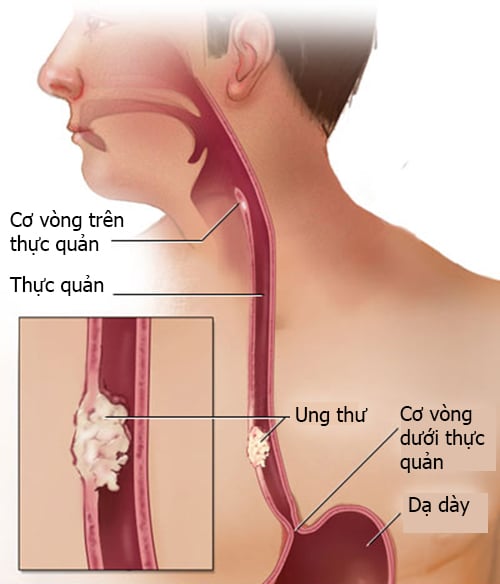 ung-thu-thuc-quan2