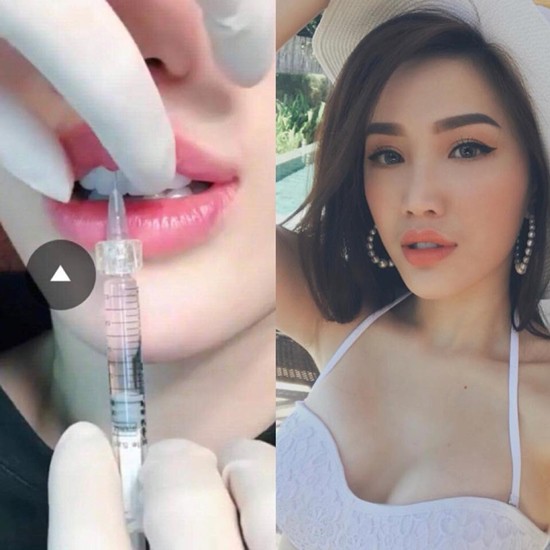Hình ảnh bơm môi khiến nữ ca sĩ vướng nghi án phẫu thuật thẩm mỹ.