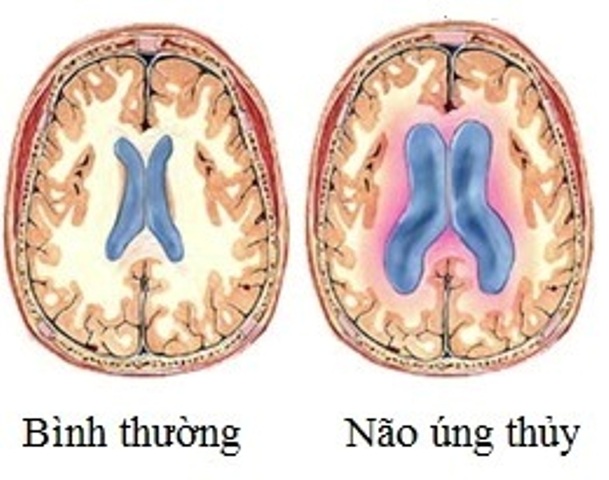 nao ung thuy 1