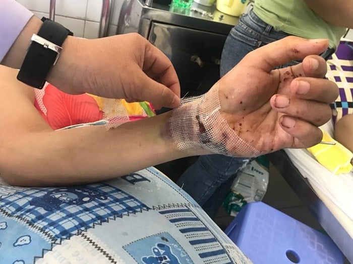 Bàn tay đứt lìa của bệnh nhân Phan Thế M. đã hồi phục sau ca phẫu thuật ghép nối thành công.